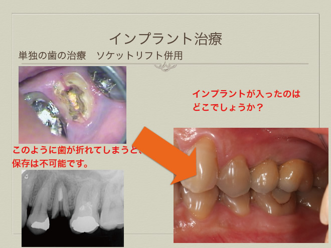 インプラント症例　単独の歯の治療2
