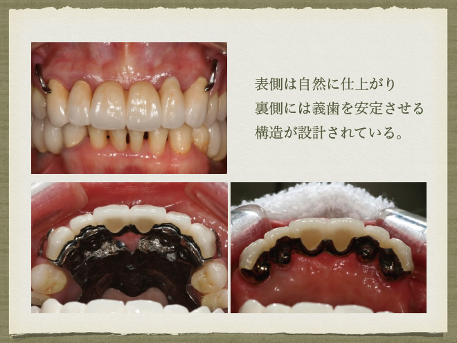 インプラントと義歯を使った治療　参考症例3