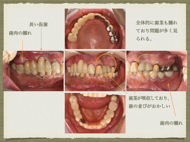 インプラントと義歯を使った治療　参考症例4