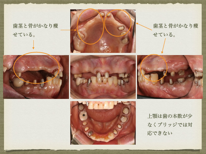 インプラントと義歯を使った治療　参考症例5