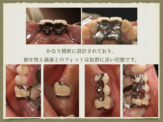 インプラントと義歯を使った治療　参考症例7