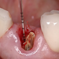 歯の破折03