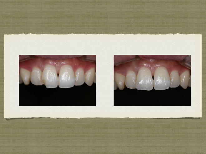 審美歯科参考症例2