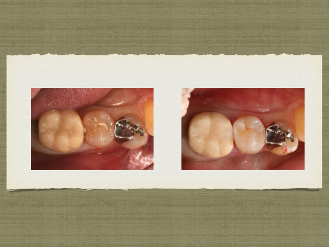 審美歯科参考症例3